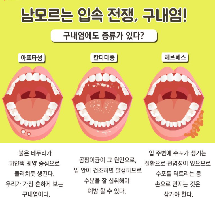  피곤하면 생기는 구내염의 원인
