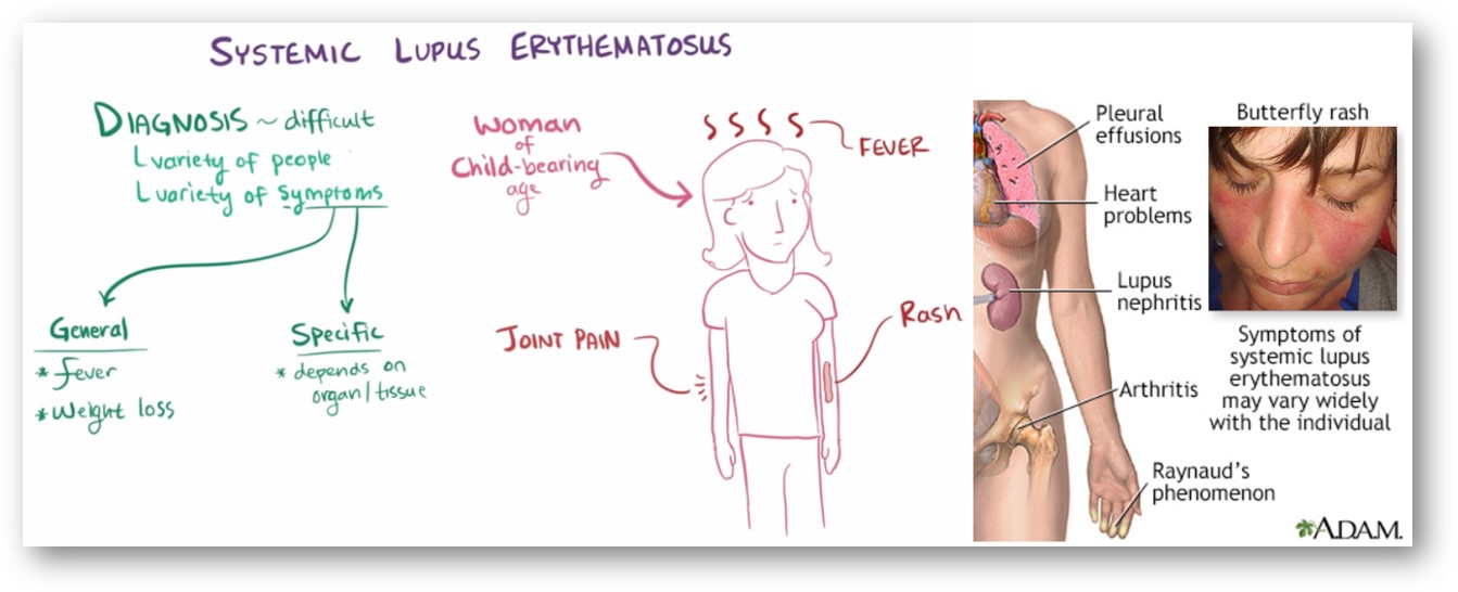 루푸스의 증상과 특징