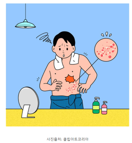 대상포진 초기증상