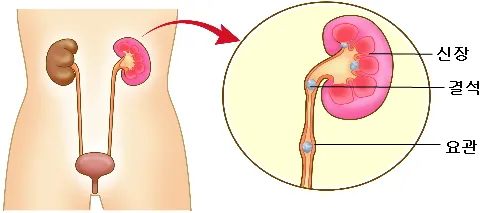 신장 결석 증상
