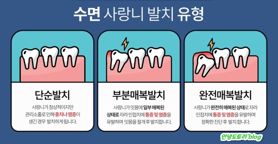 사랑니가 자라는 시기와 발치, 주의사항을 알아두다