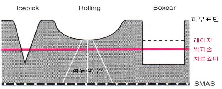 여드름흉터의형태