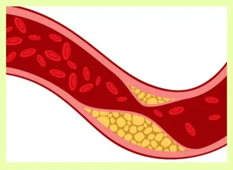 LDL 콜레스테롤 정상수치 낮추는법_4