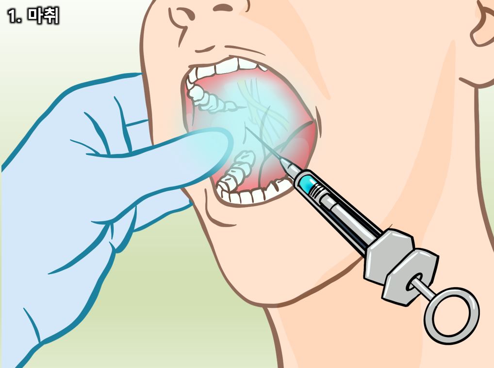 사랑니 발치 과정과 통증, 신경 손상에 대한 모든 것