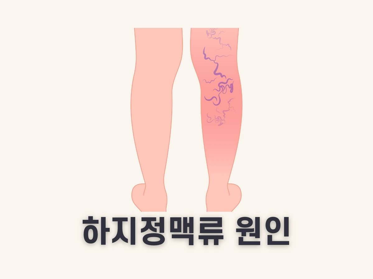 하지정맥류 원인