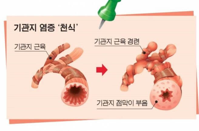 천식 증상