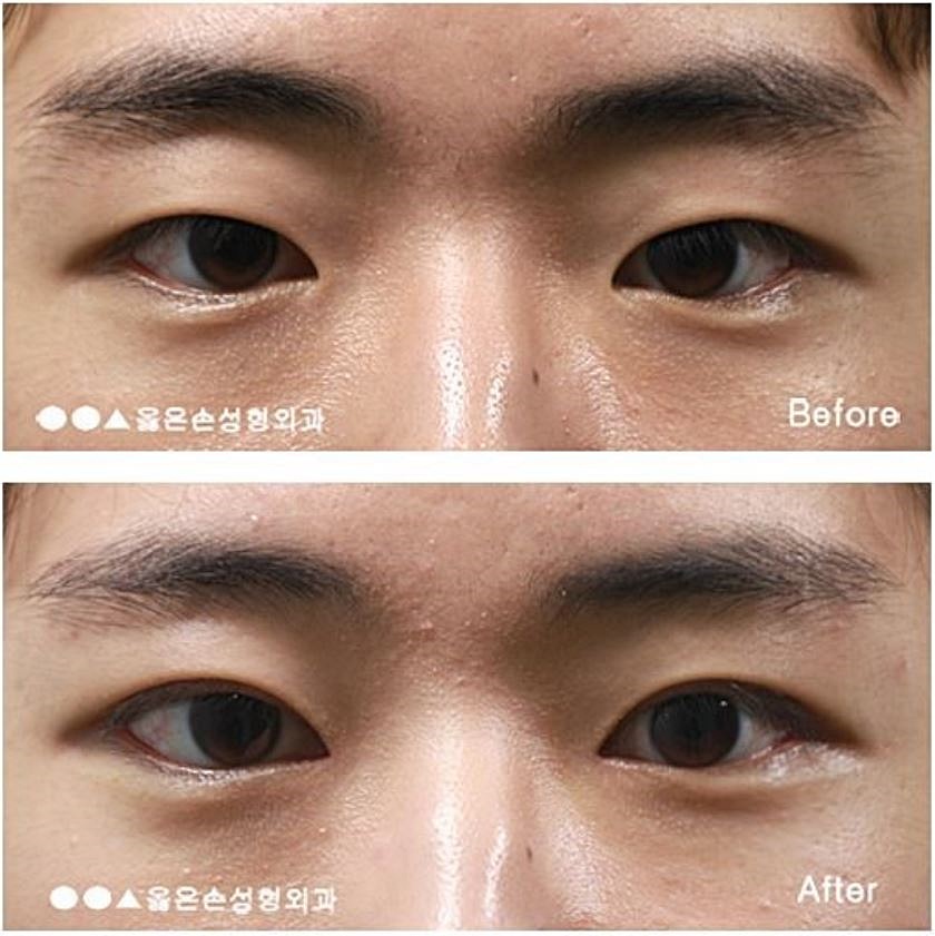 상안검 수술 후기 반드시 참고해야 한다 11