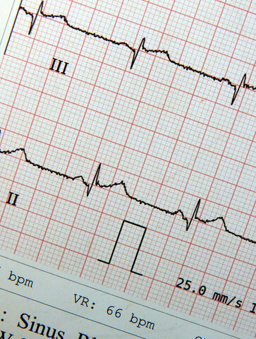 심박출량 감소 간호진단 : Decreased Cardiac Output