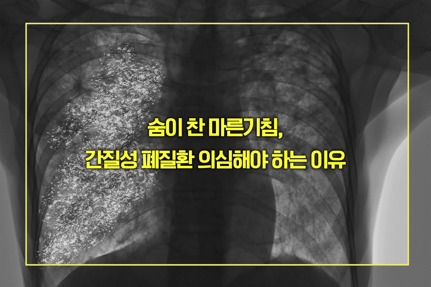 숨이 찬 마른기침 간질성 폐질환 의심