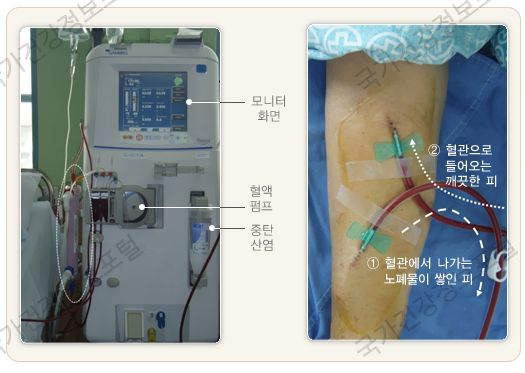 혈액투석방법