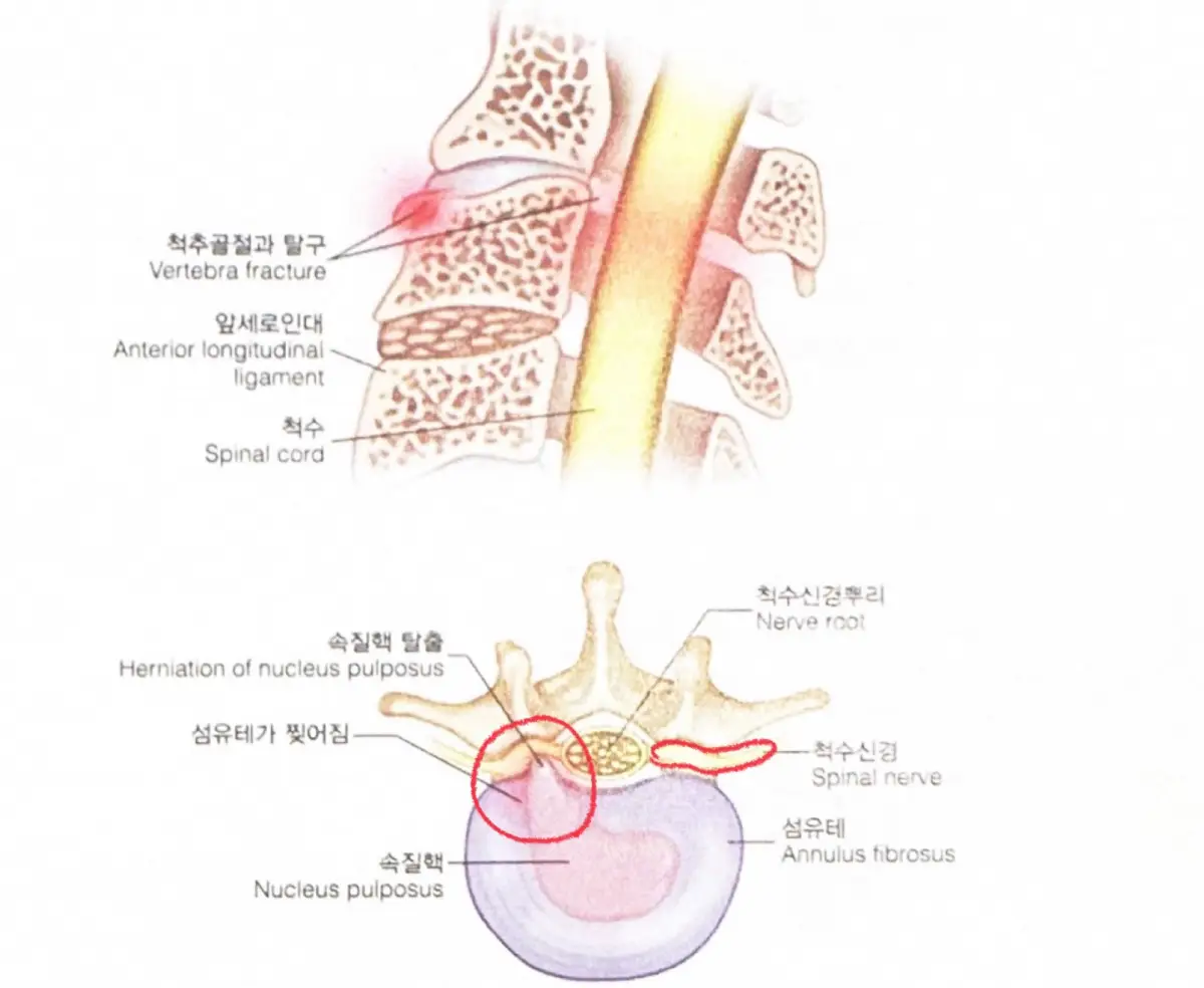 추간판탈출증-디스크