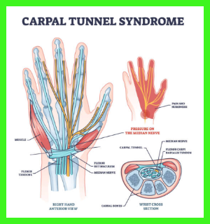 손목터널증후군의 원인 ❘ 증상 ❘ 치료방법 ❘ 예방