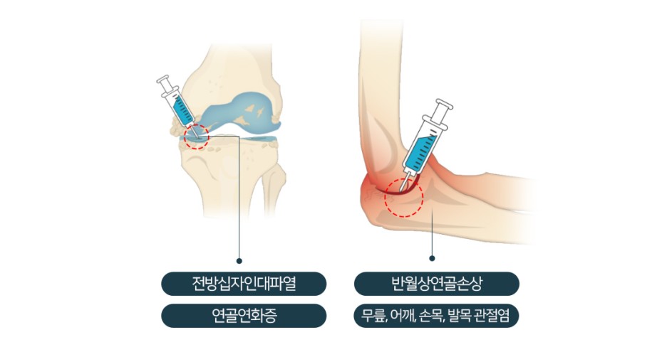 [프로필 치료/프로필러 주사] 프롤린 주사 부작용은? 7