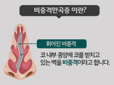  코골이 그만, 비중격만곡증(feat. 비염)