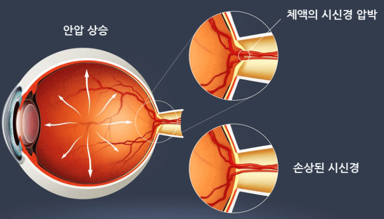  녹내장 종류별 증상 알기(중요!) - 원인 6가지 , 치료 , 예방법까지