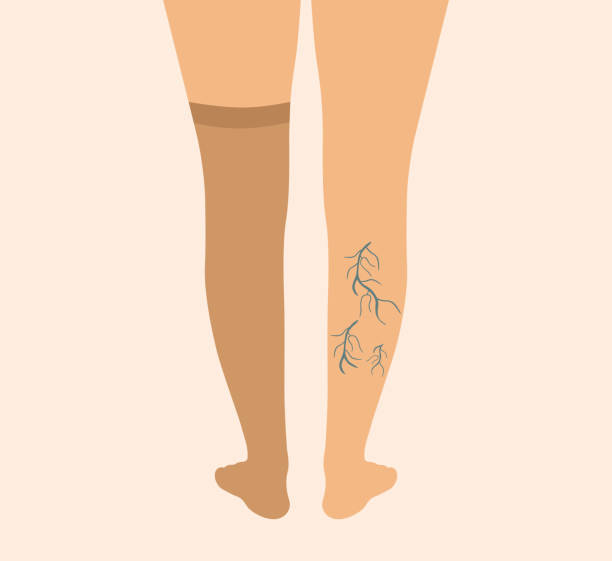  "하지정맥류(Varicose vein) 이해 : 원인, 증상 및 치료 방법"