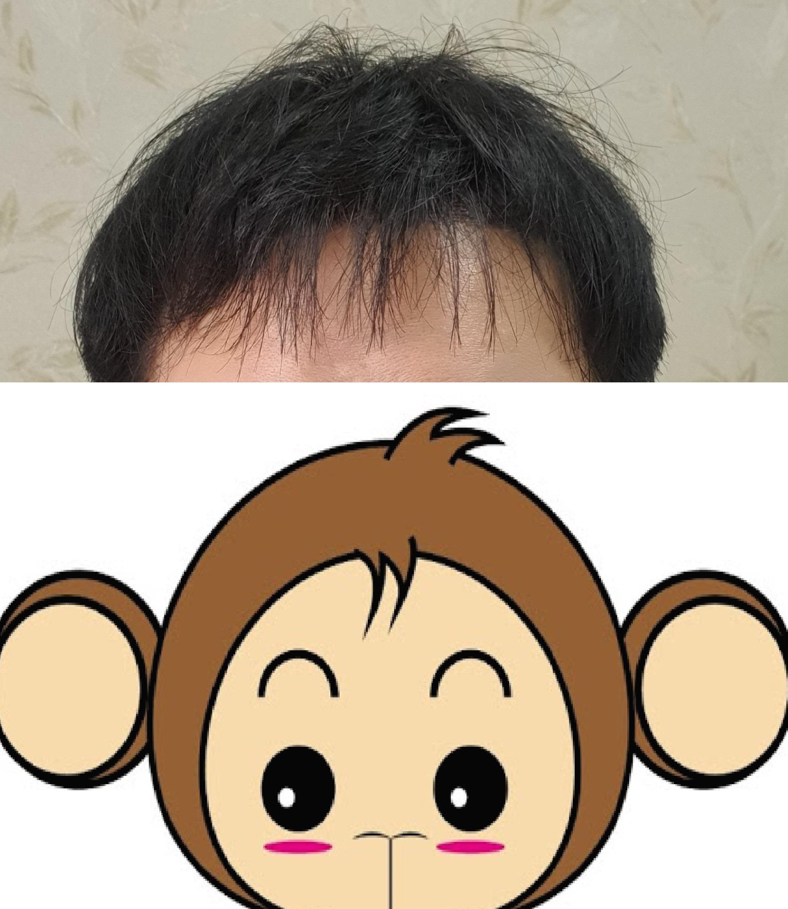  3600모 모발이식 비절개 시술 3일차 (출근후기)
