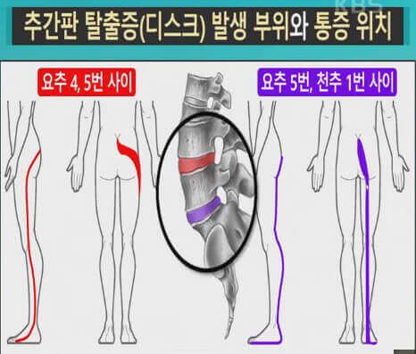  팔다리 떨림, 저림, 시림, 뻣뻣함, 힘 빠짐 증상 분석 및 대처