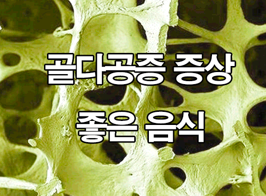 골다공증 증상 및 좋은 음식