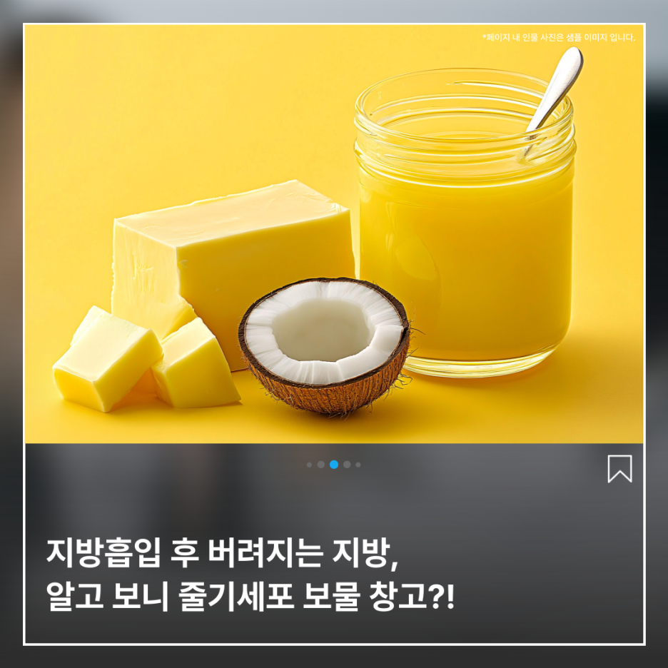 img 지방흡입 후 버려지는 지방, 알고 보니 줄기세포 보물 창고?!
