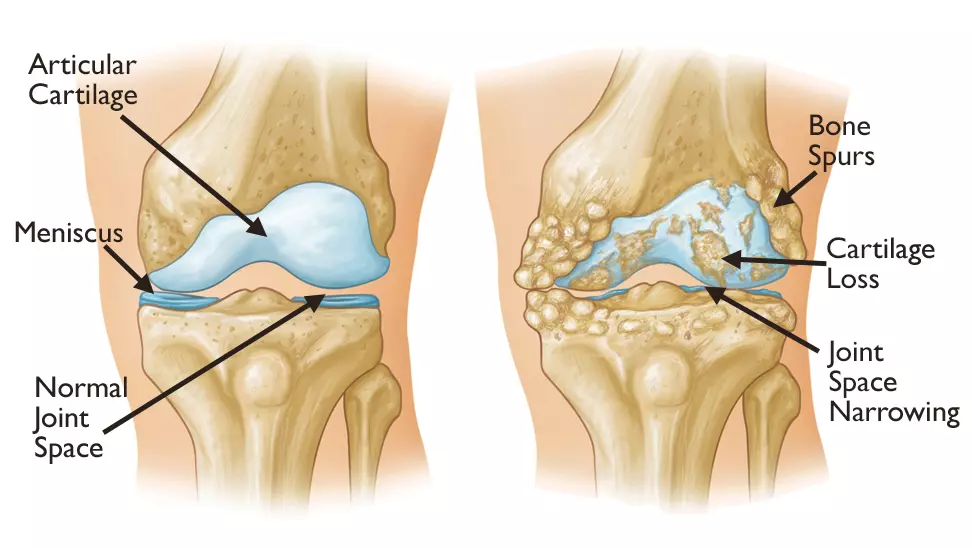 골관절염(Osteoarthritis&#44; OA)