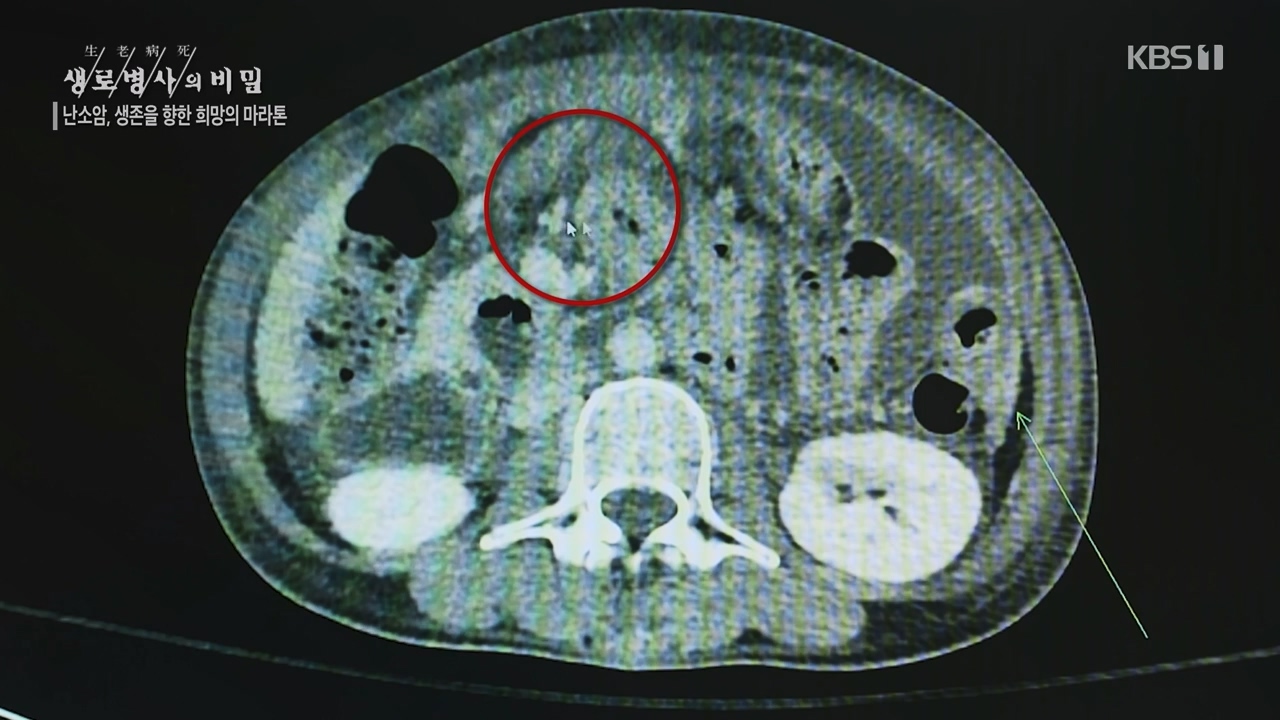 생로병사의 비밀.E878.230803p-NEXT.mp4_20230805_155629.090.jpg