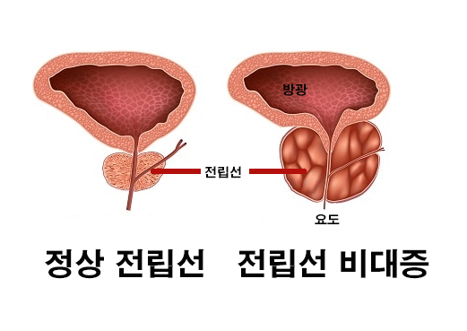 전립선 비대증 원인 - 전립선이 커지는 이유