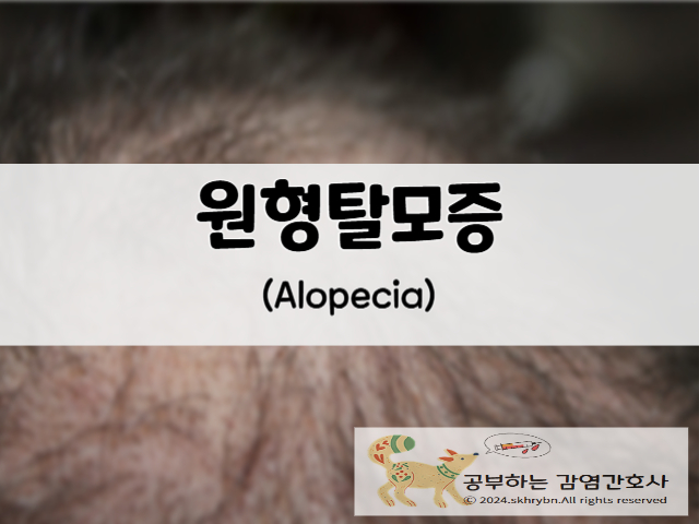 간호사가 말하는 &quot;원형 탈모(alopecia areata)&quot;의 원인, 증상 치료법 비용