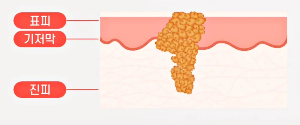 피부겉면인 표피-기저막-진피