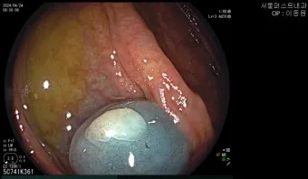 대장내시경 용종제거 후 식사 식단조절_50