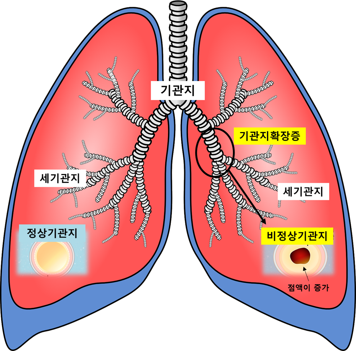 기관지에서 염증이나 자극을 받아 점차 분비되는 증상 (가래 발생)