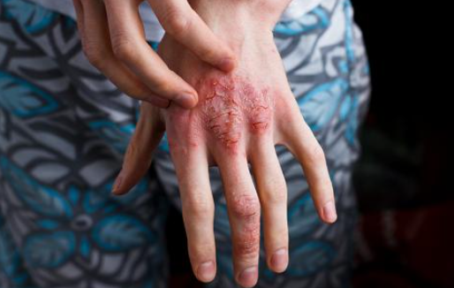 아토피성 피부염 손의수부현상