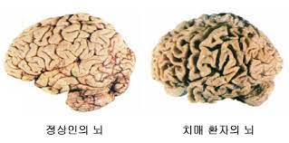 정상인과 치매 뇌구조의 다름
