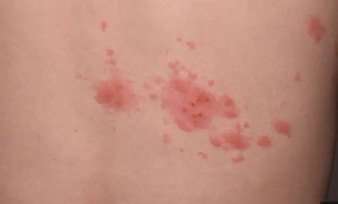 대상포진통증정도