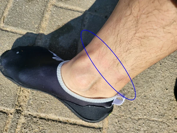 해파리 응급처치