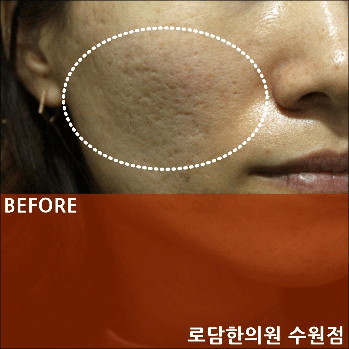  수원여드름흉터 롤링성 패인흉터 치료 과정 새살침