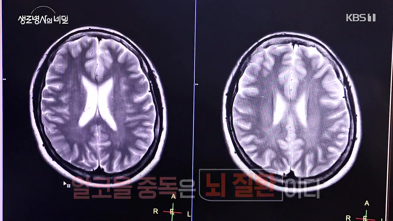 생로병사의 비밀.E915.240613p-NEXT.mp4_20240613_195303.265.jpg