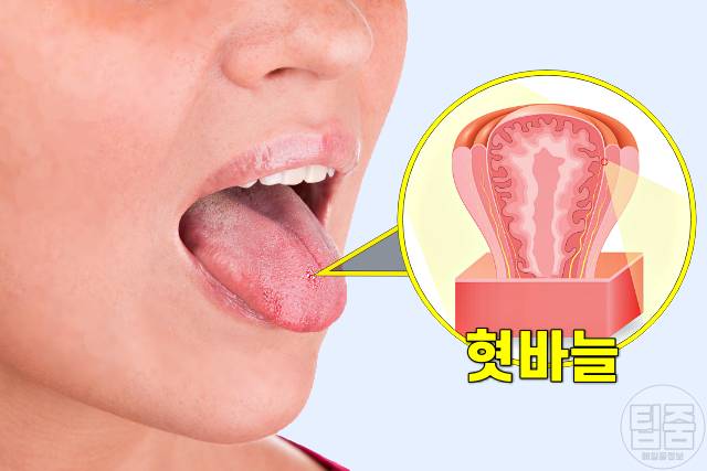 혓바늘 치료 빨리 낫는 법,구내염에 좋은 음식