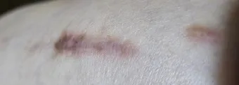 흉터전용 치료 추천 스카덤 겔 효능효과_11