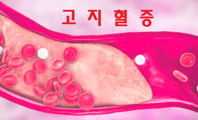  고지혈증이 우리 몸에 미치는 영향, 합병증의 주범 고혈압과 당뇨