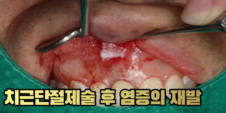 염증재발