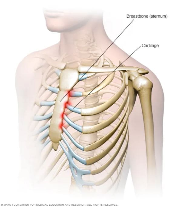 늑골염(갈비뼈염)의-통증은-주로-가슴-중앙에서-느껴짐