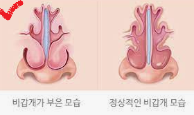 비염비염