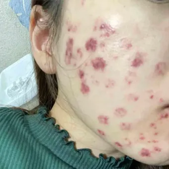 흉터전용 치료 추천 스카덤 겔 효능효과_26