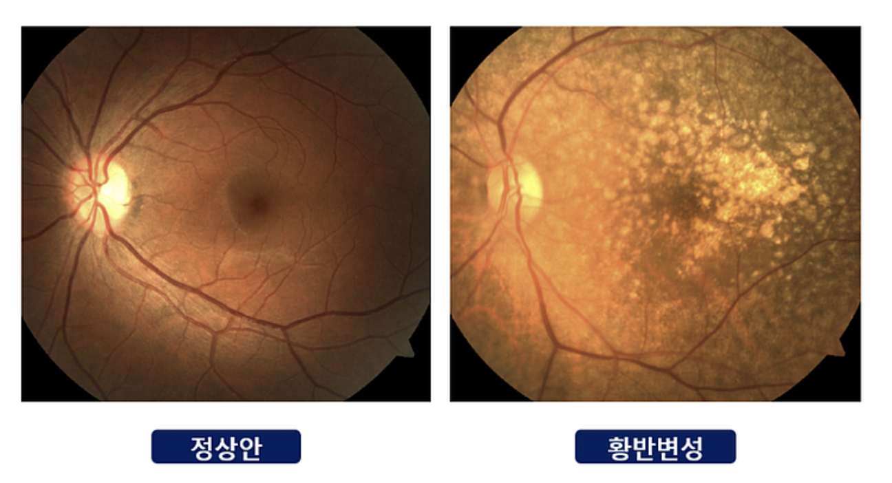 황반변성-정상안구-차이