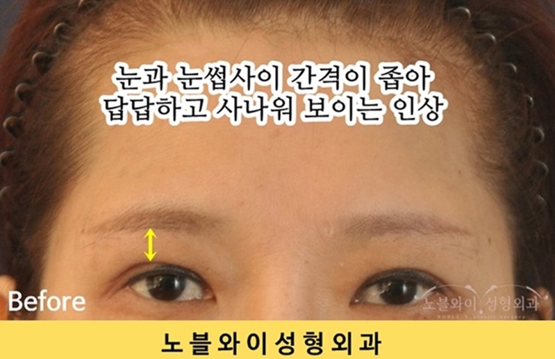  내시경이마눈썹거상술 탈모는 없나요?