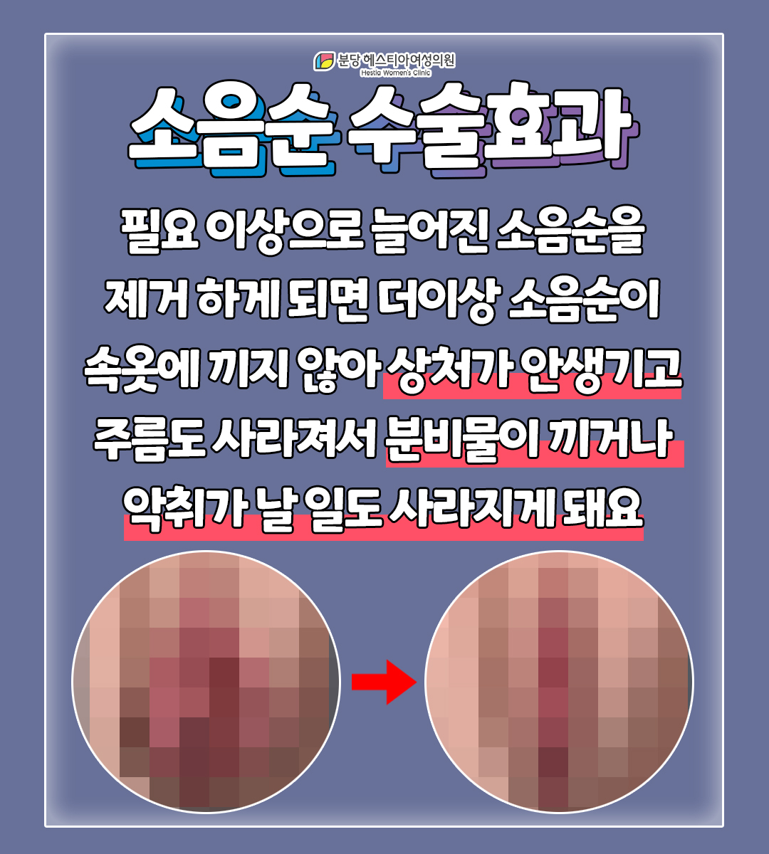 동천역산부인과 생식기 상처 회음부 분비물 소음순 수술 효과 좋나요?