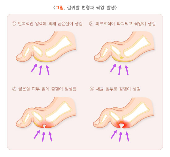 당뇨병-족부병증-신경병증