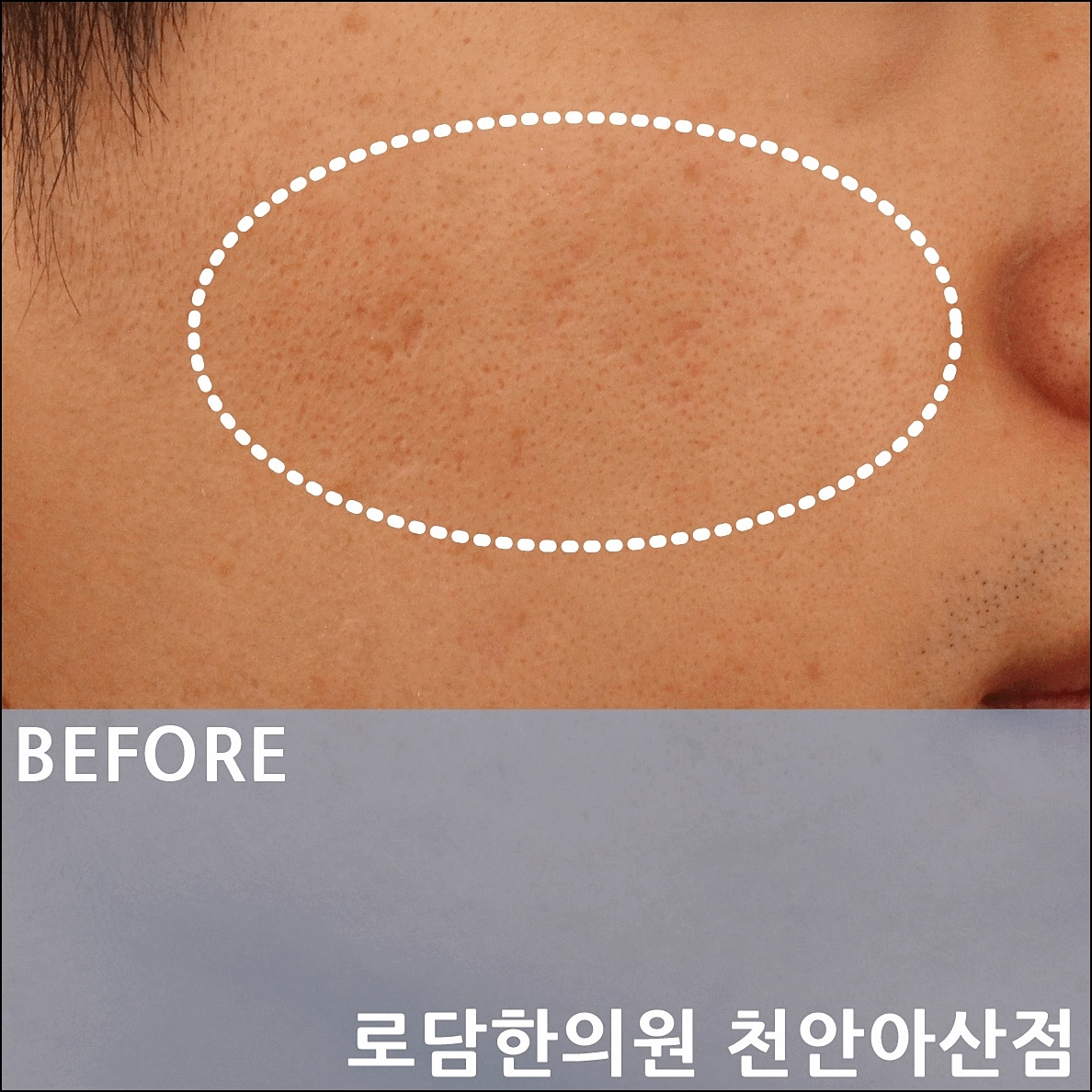  천안 여드름 흉터 새살침 한의원 치료 과정