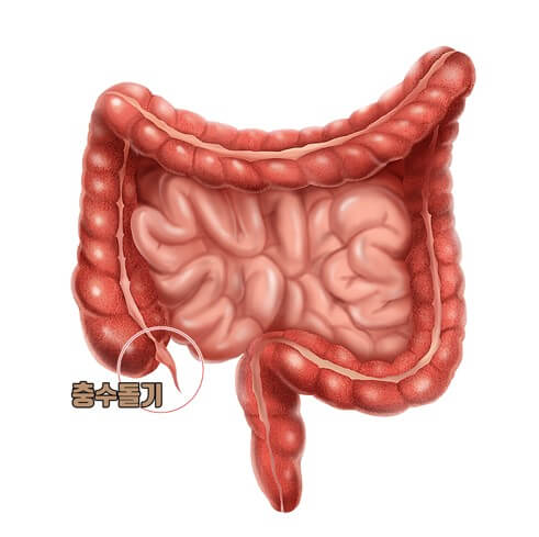 맹장염 초기 증상 5가지 및 맹장 위치